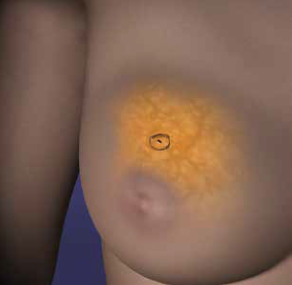 Illustration of a breast with the location of the reflector placement