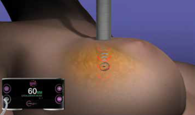 Illustration of the SCOUT* system being used on a breast