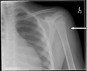 Paediatric Proximal Humerus Fracture CUH