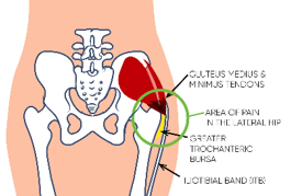 Diagram of the hip, indicating the area of pain for GTPS (green circle). Also shows Gluteus medius and minimus tendons, the Greater trochanteric bursa and the Iliotibial band (ITB).