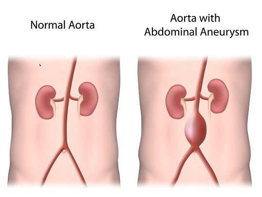 107252 - Normal aorta and aorta with aneurysm