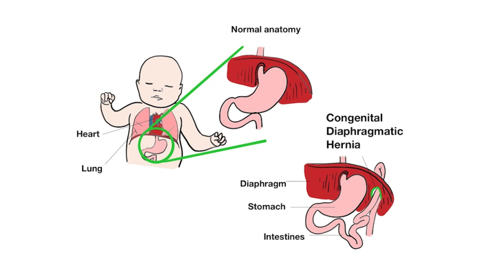 diagram showing the difference between the normal anatomy of the diaphragm and a congenital diaphragmatic hernia, labelled: heart, lung, diaphragm, stomach, intestines