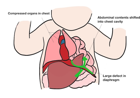 Diagram showing the effects of a large defect in the diaphragm, labelled: compressed organs in chest, abdominal contents shifted into chest cavity, large defect in diaphragm