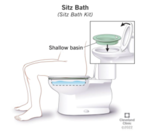 Illustration of a Sitz Bath with 'shallow basin' labelled.