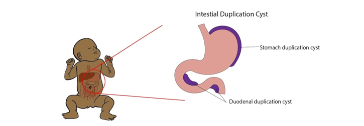 Medical illustration showing an infant diagram with highlighted abdominal area and labelled diagram of intestinal duplication cysts involving the stomach and duodenum.