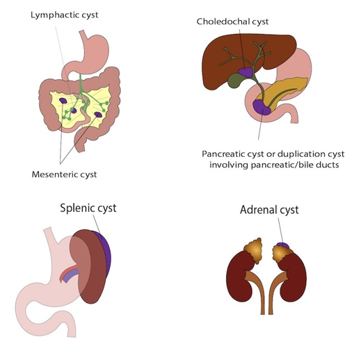 Labeled medical diagrams showing types of abdominal cysts, including lymphatic, mesenteric, choledochal, pancreatic, splenic, and adrenal cysts.