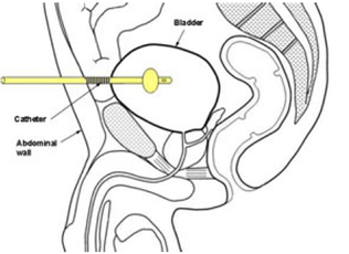 Diagram of the catheterisation process, showing the catheter position inside the bladder. Abdominal wall is also labelled.