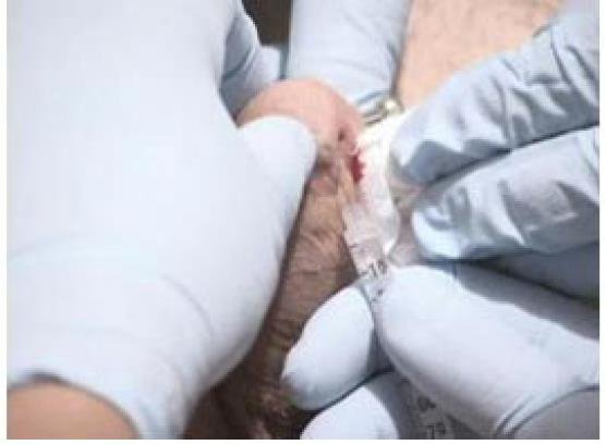 Meatotomy procedure- two hands injecting a piece of skin