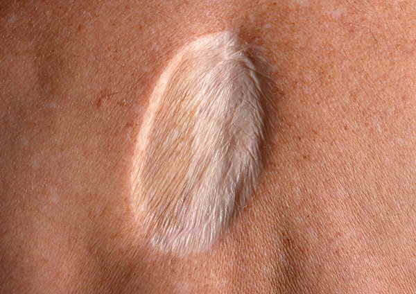 A skin graft scar