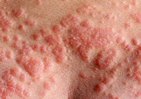 Lichen Simplex Chronicus on skin