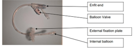 A Vygon Mic G tube used as a direct Jejunal tube, labelled: enfit end, balloon valve, external fixation plate, internal balloon