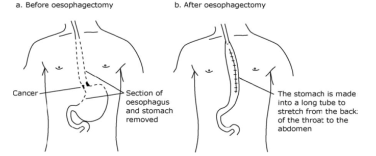 Illustration of the stomach before and after having an oesophagectomy