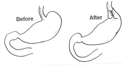 Diagram showing before and after fundoplication