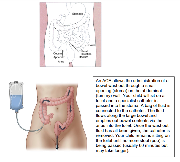 A diagram of the abdomen showing the stomach, colon, small intestine, rectum, cecum, appendix, anus and a bag of fluid connected to a catheter being passed through a stoma.