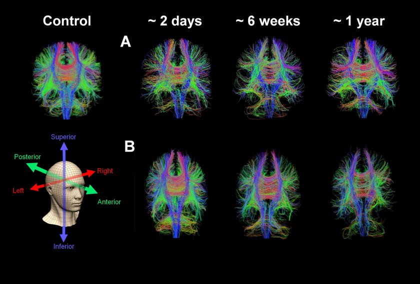 DTI brain injury MRI