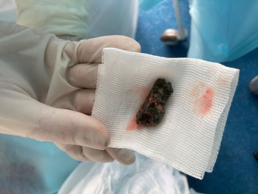 A piece of shrapnel removed from a patient’s chest