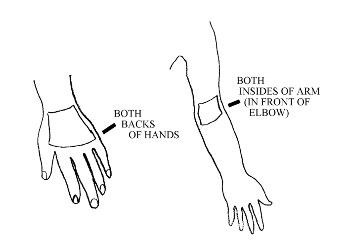 Illustration on the left is of a dressing on the back of a left hand. The illustration on the right is of a dressing on the inside of the elbow on the right arm