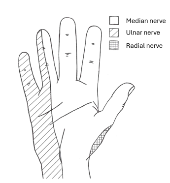 Illustration of right hand with the little finger and half of the third finger shaded in diagonal lines = ulnar nerve, the lower part of the thumb is shaded with a tiny squares = the radical nerve and the rest of the hand = median nerve