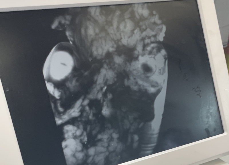 A screen showing a black and white image of dissected tissues displayed using infrared light to help detect lymph nodes