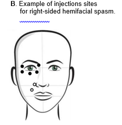 Illustration of a face with dots indicating example of injection sites for right-sided hemifacial spasm
