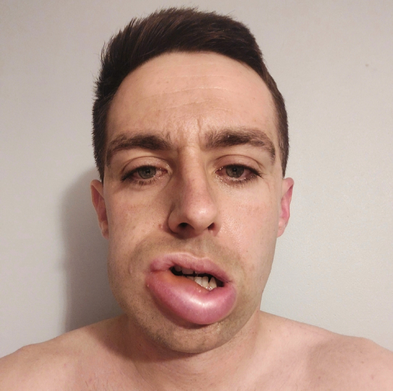A face-on image of Jack showing a large swelling of his lower lip and jaw