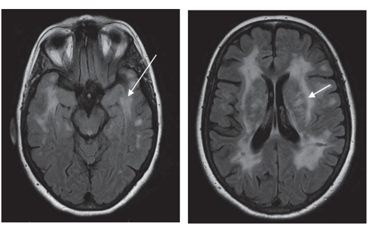 MRI scans of brain: Anterior temporal lobes (left, arrowed) and external capsules (right, arrowed) of the brain