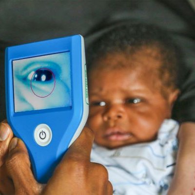 A Neocam device in use on a baby, showing a close-up image of the baby's eye on its screen. A red circle highlights the eye on the display.