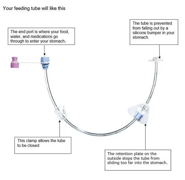 Diagram of a feeding tube with labelled parts: the end port for food, water, and medication; a clamp to close the tube; an internal silicone bumper to prevent slipping; and an external retention plate to stop the tube moving too far into the stomach.