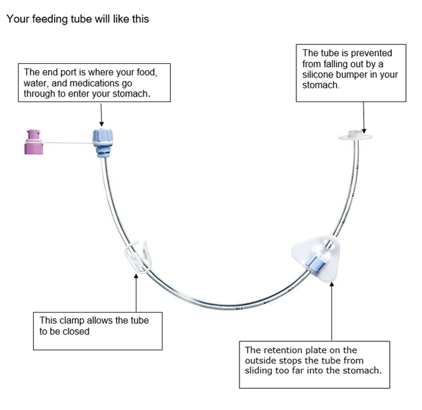 Feeding tube