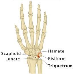 Triquetral fracture