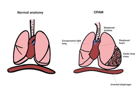 Illustration comparing normal lung anatomy with congenital pulmonary airway malformation (CPAM), showing altered lung structure and displacement of nearby organs in CPAM.