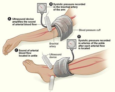 A diagram of an arm with a blood pressure cuff