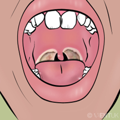 throat
