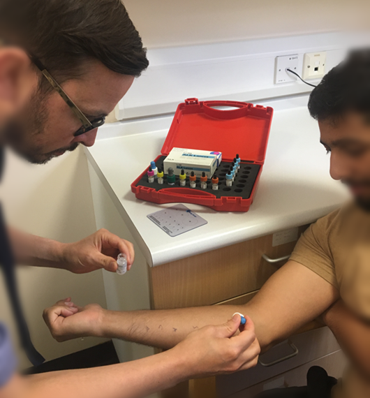 Patient having a skin prick allergy test