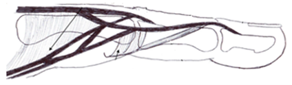 Diagram of the extensor tendon mechanism of a finger in normal alignment, showing the central slip and lateral bands over the finger joints.