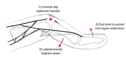 Diagram showing central slip rupture, downward migration of the lateral bands, and hyperextension of the fingertip joint.