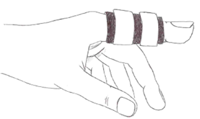 Hand with the ring finger and little finger strapped together using three buddy-tape bands.
