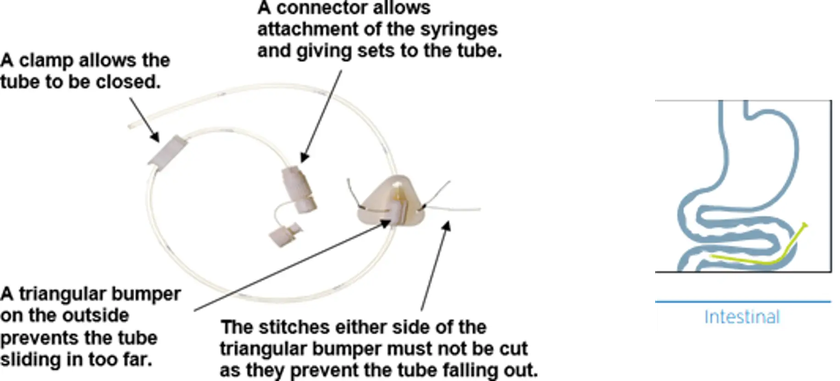 Labelled image of a feeding tube system: a clamp controls flow, connectors attach syringes or giving sets, and a triangular external bumper held by stitches prevents the tube from moving inward or dislodging.