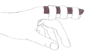 Hand with two fingers secured together using four buddy-tape loops extending from the base to the fingertip.