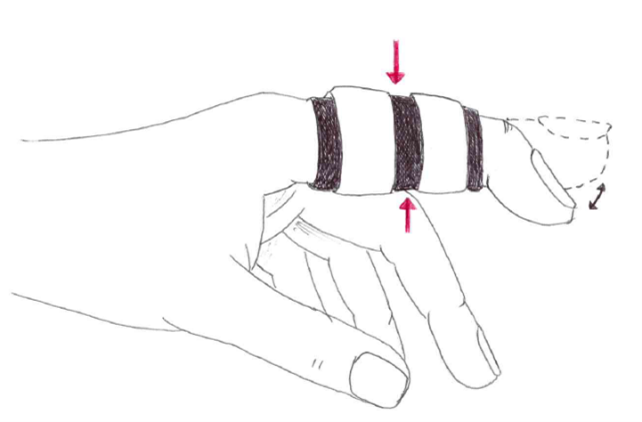 Hand with two fingers buddy-taped together using three tape strips, with arrows indicating gentle compression and support of the injured finger.
