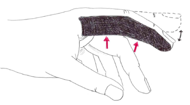 Hand with a finger supported by a dorsal tape splint along the back of the finger, with arrows indicating upward support to maintain finger extension.