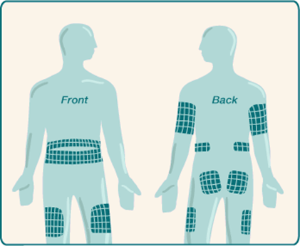 Diagram of front and back human silhouettes showing recommended infusion set sites: abdomen, thighs, lower back, upper arms, and buttocks, marked with grid patterns.