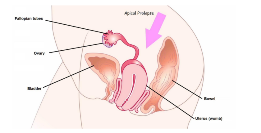 Diagram of a apical prolapse