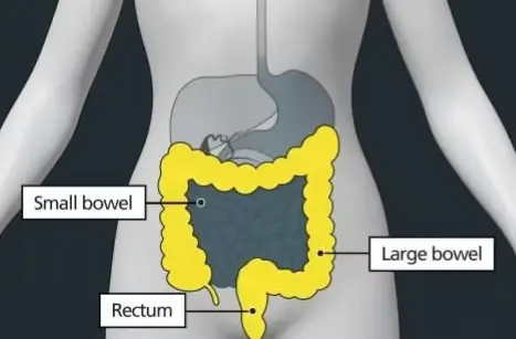 Diagram of parts of the anatomy, labelled: small bowel, rectum, large bowel