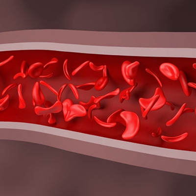 Sickle cell