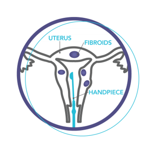 Diagram of the female reprodctive system undergoing Sonata treatment, labelled: uterus, fibroids, handpiece