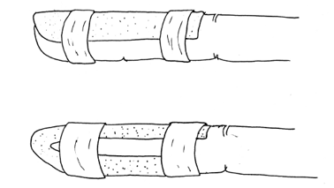 Illustration of a splint positioned on the index finger