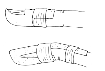 Illustration of splint on index finger with the top of finger slightly bent