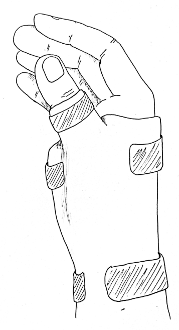 Illustration of typical splint on hand following Trapeziectomy