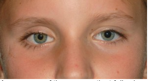 Both eyes after surgery with artifical right eye